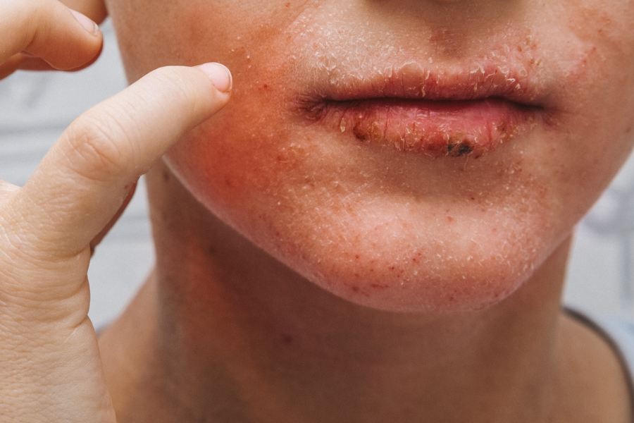 Why Infections
Keep Coming Back