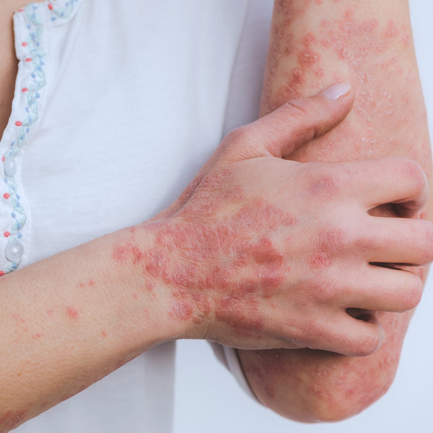 Histamine Healing Bundle